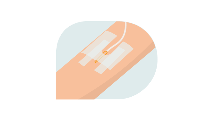 Infuustherapie: Perifeer infuus en PICC lijn